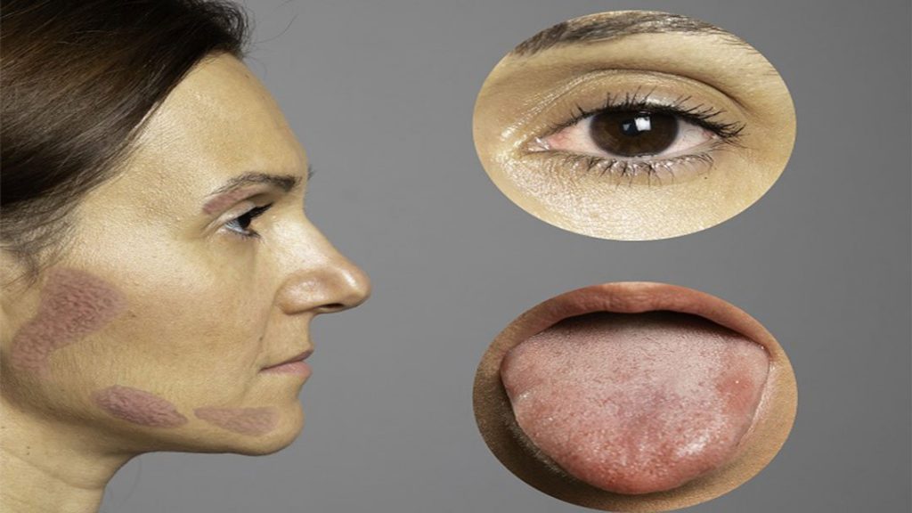 سندروم شوگرن چیست و تا چه حد خطرناک است؟